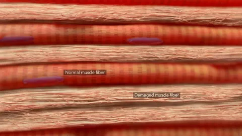 Damaged muscle fibers are gradually replaced by fat and fibrous connective tissue.